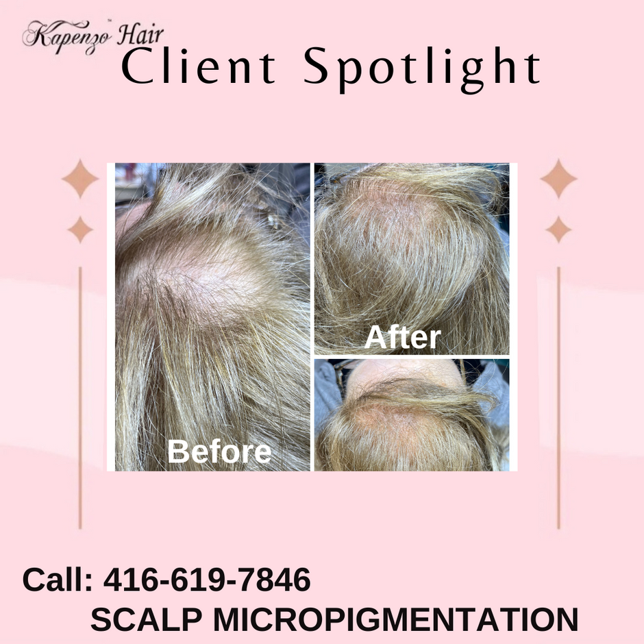 SCALP MICROPIGMENTATION