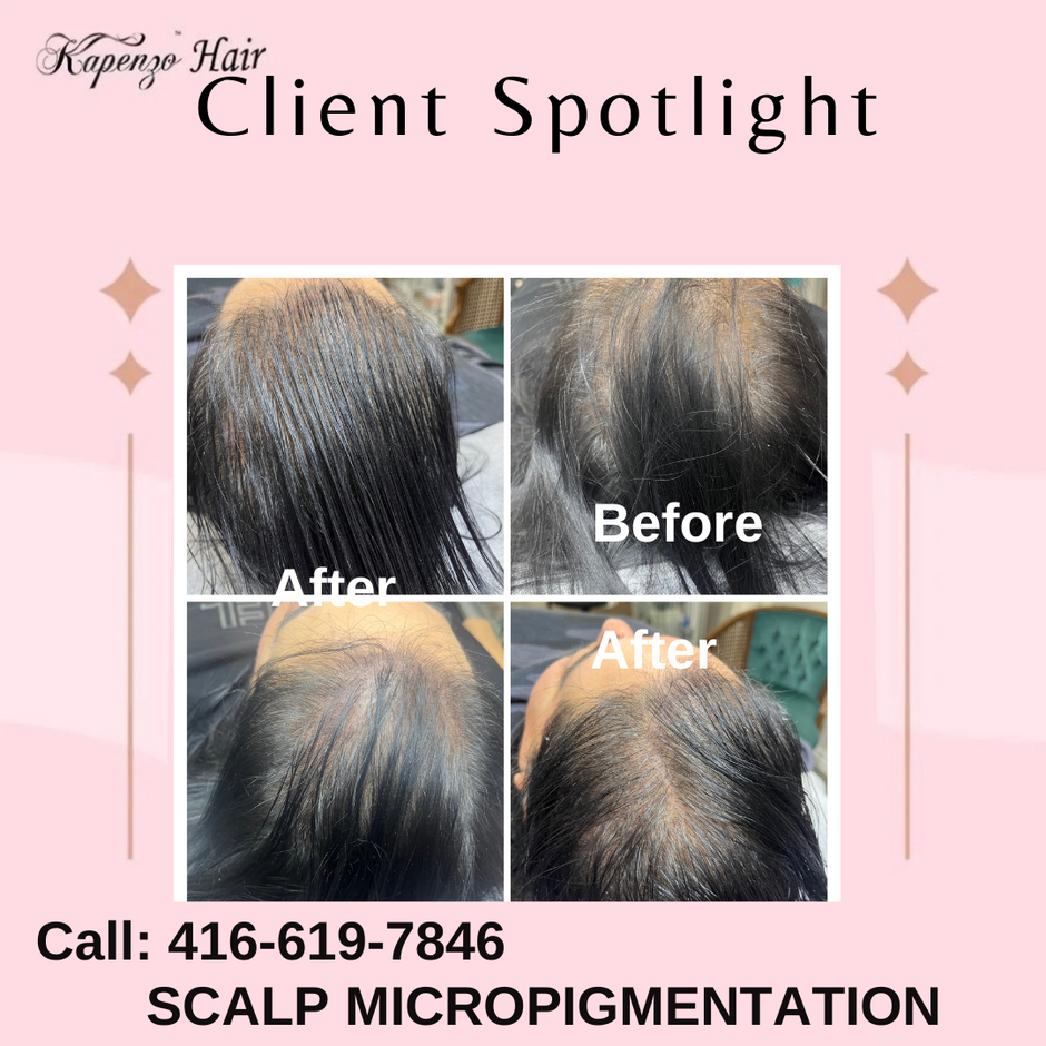 SCALP MICROPIGMENTATION