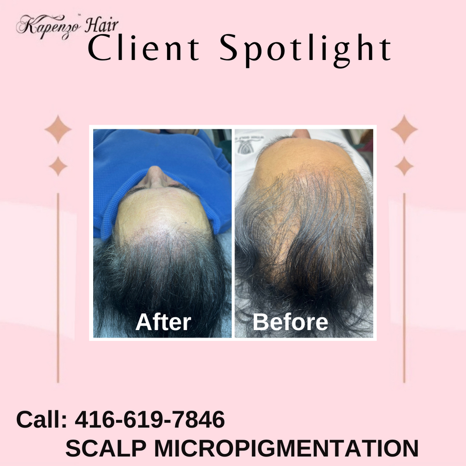 SCALP MICROPIGMENTATION