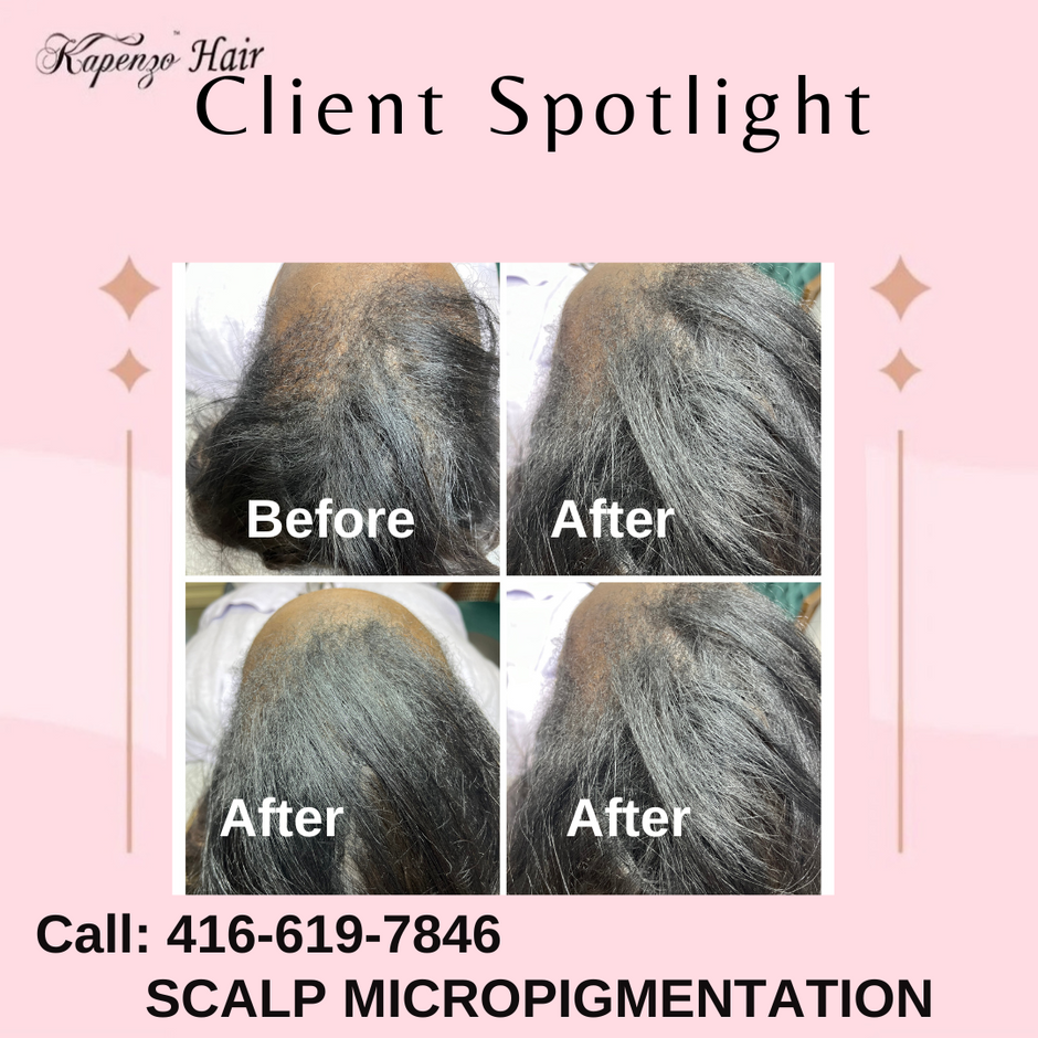 SCALP MICROPIGMENTATION